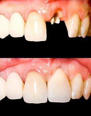Use hot water to re-shape Billy Bob teeth for a perfect fit. . How to make teeth with thermal beads